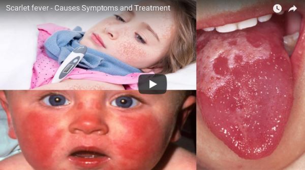 Scarlet-fever--Causes-Symptoms-and-Treatment_video